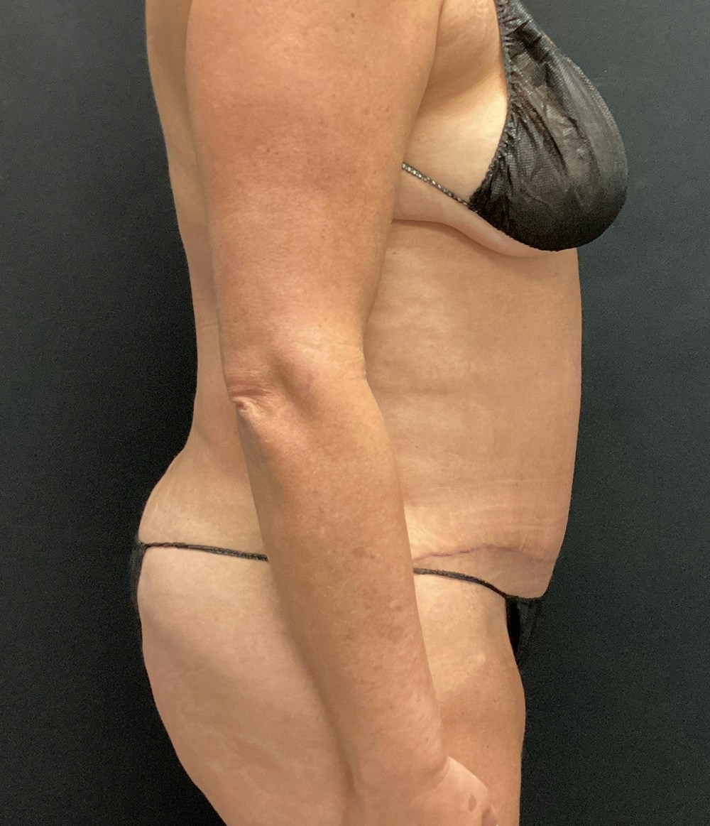Tummy Tuck Before & After Gallery - Patient 102682444 - Image 6