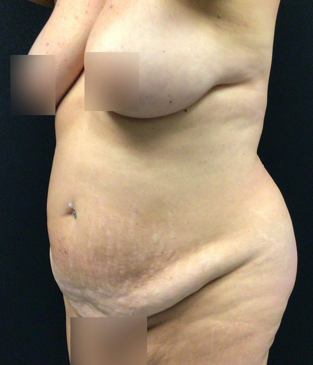 Tummy Tuck Before & After Gallery - Patient 102682444 - Image 7