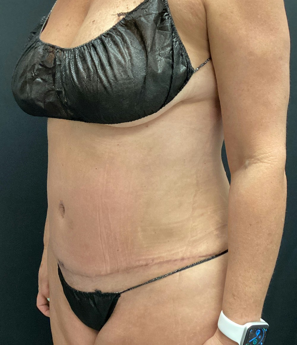 Tummy Tuck Before & After Gallery - Patient 102682444 - Image 8