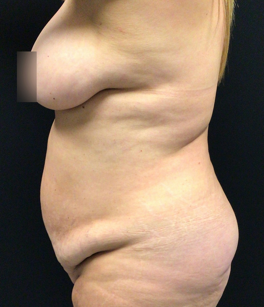 Tummy Tuck Before & After Gallery - Patient 102682444 - Image 9