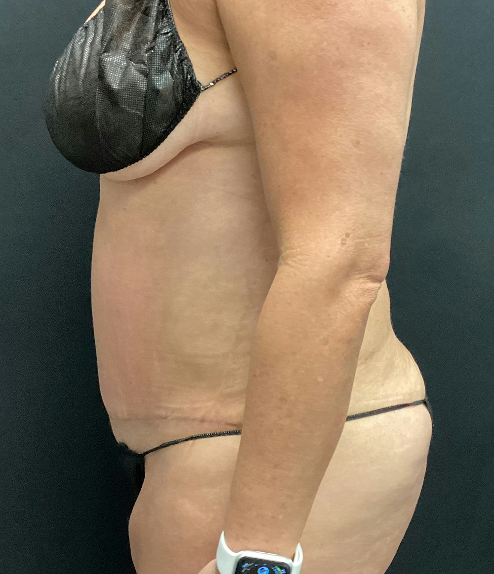 Tummy Tuck Before & After Gallery - Patient 102682444 - Image 10