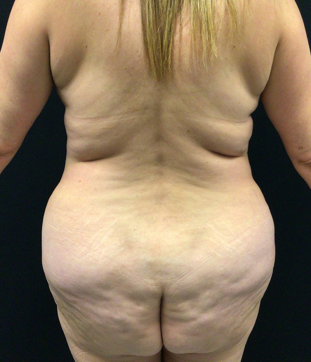 Tummy Tuck Before & After Gallery - Patient 102682444 - Image 11