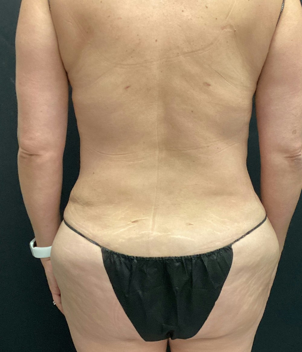 Tummy Tuck Before & After Gallery - Patient 102682444 - Image 12