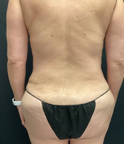 Tummy Tuck Before & After Gallery - Patient 102682444 - Image 12