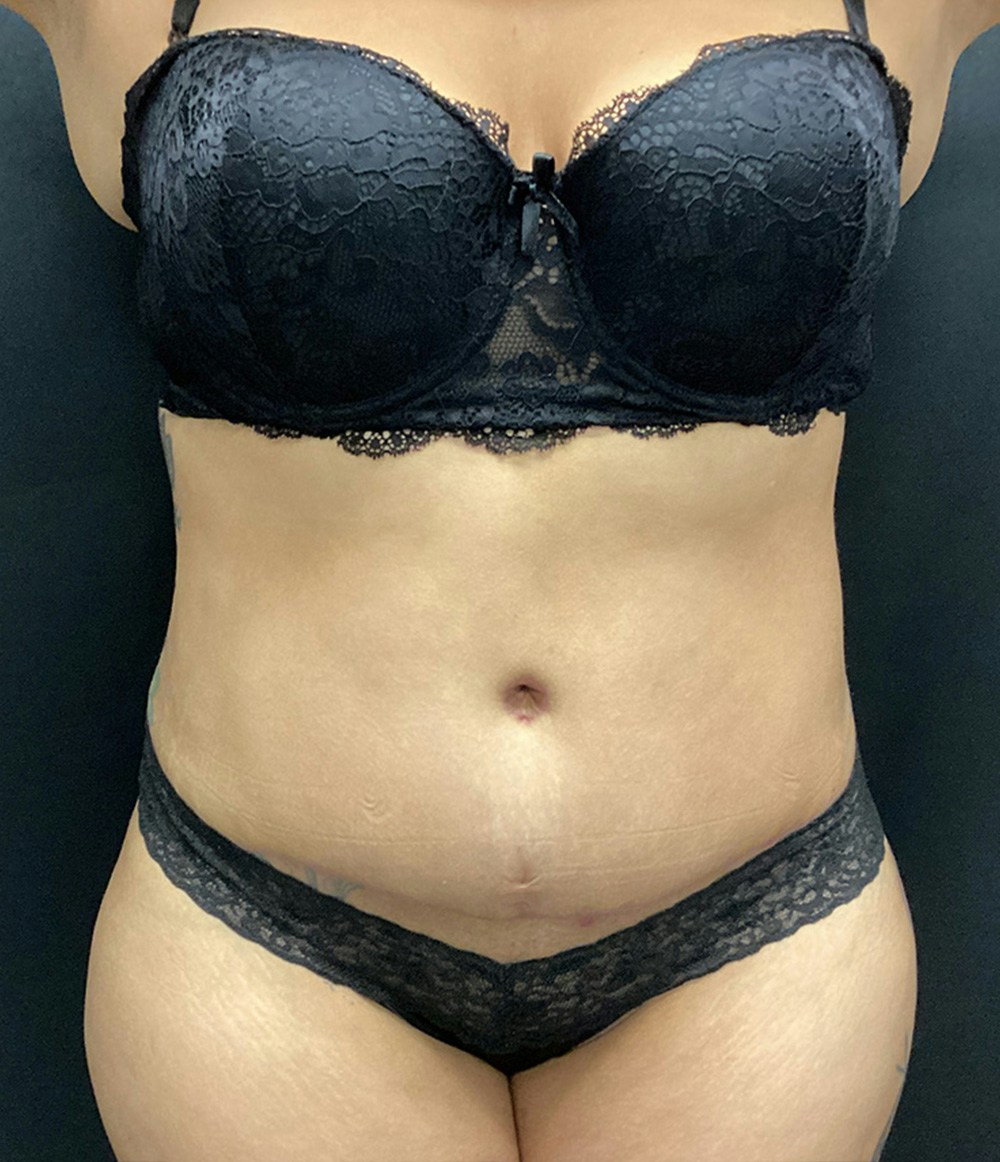 Liposuction Before & After Gallery - Patient 74784377 - Image 2
