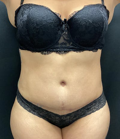 Liposuction Before & After Gallery - Patient 74784377 - Image 2