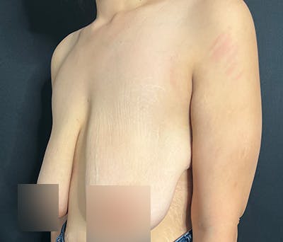 Breast Lift Before & After Gallery - Patient 340187 - Image 1