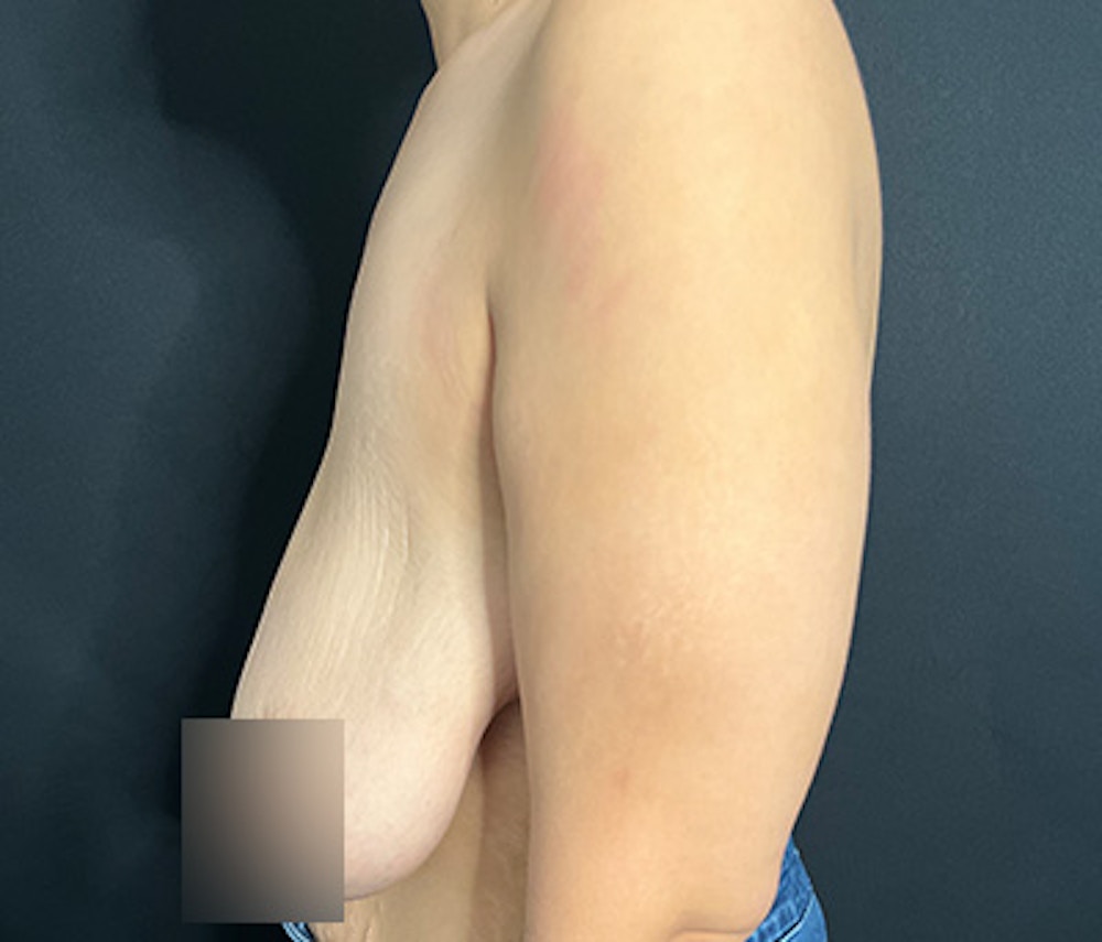 Breast Lift Before & After Gallery - Patient 340187 - Image 3