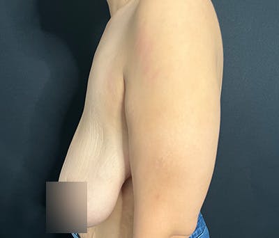 Breast Lift Before & After Gallery - Patient 340187 - Image 3