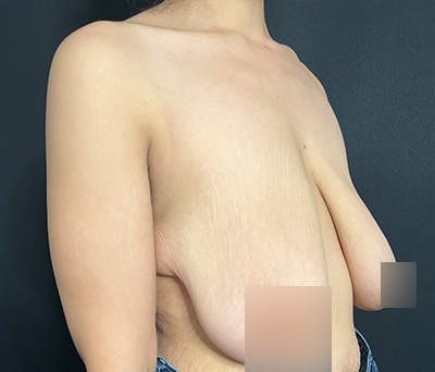 Breast Lift Before & After Gallery - Patient 340187 - Image 5