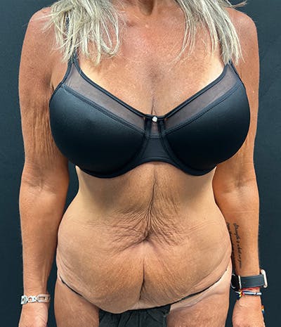 Tummy Tuck Before & After Gallery - Patient 159223 - Image 1