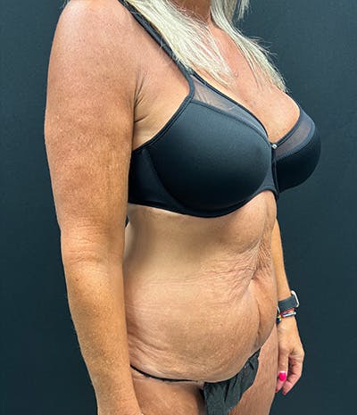 Tummy Tuck Before & After Gallery - Patient 159223 - Image 3