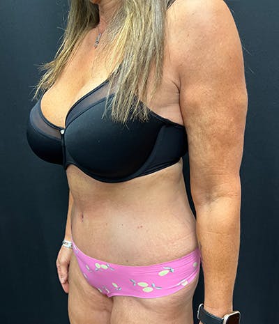 Tummy Tuck Before & After Gallery - Patient 159223 - Image 6