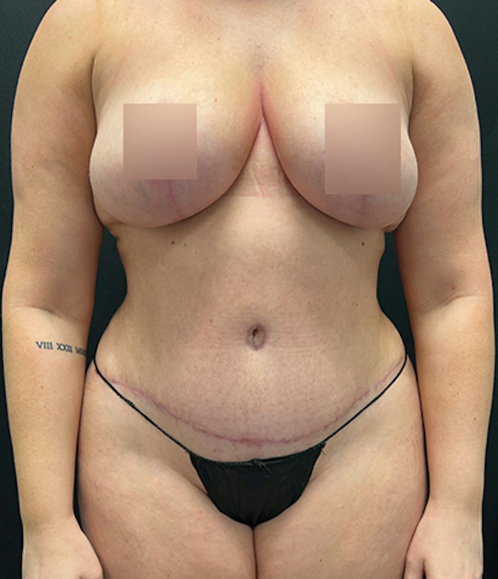 Tummy Tuck Before & After Gallery - Patient 260584 - Image 2