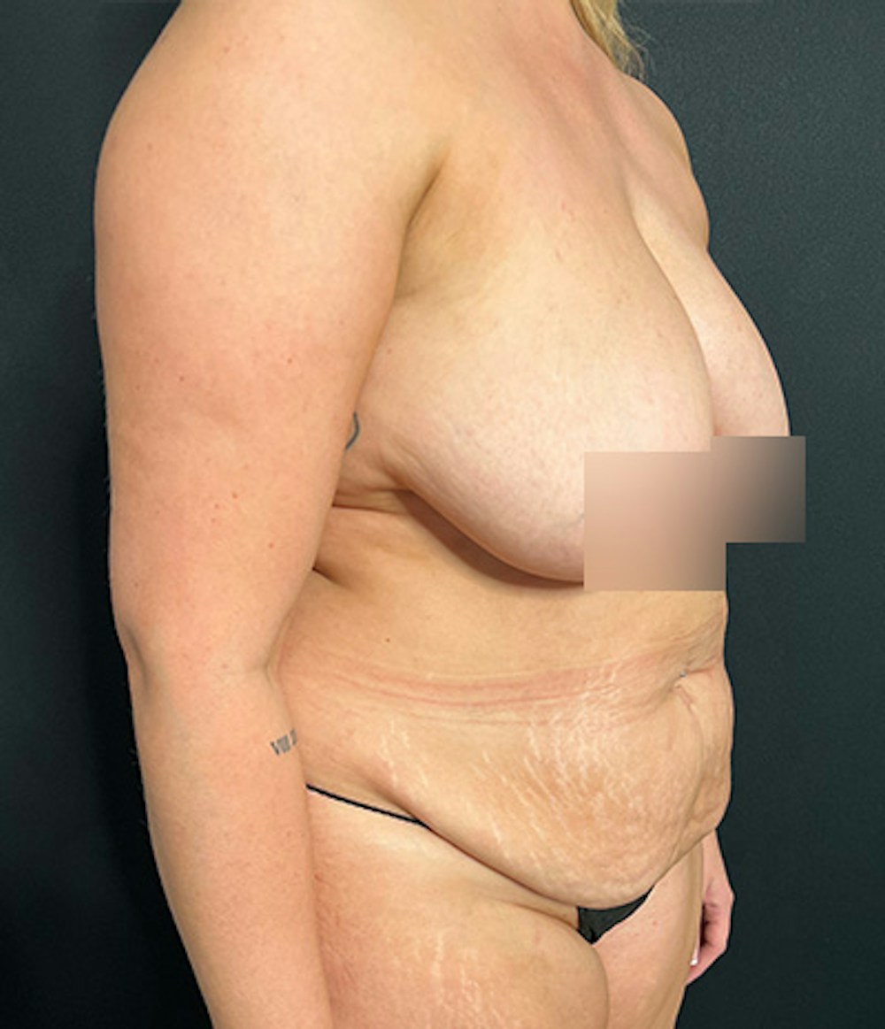 Tummy Tuck Before & After Gallery - Patient 260584 - Image 3