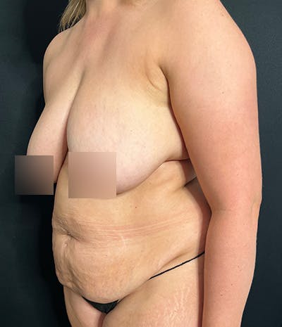Tummy Tuck Before & After Gallery - Patient 260584 - Image 5