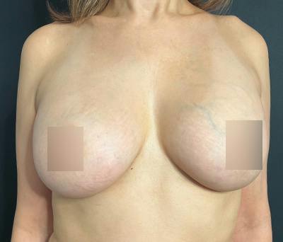 Breast Augmentation Before & After Gallery - Patient 242670 - Image 2