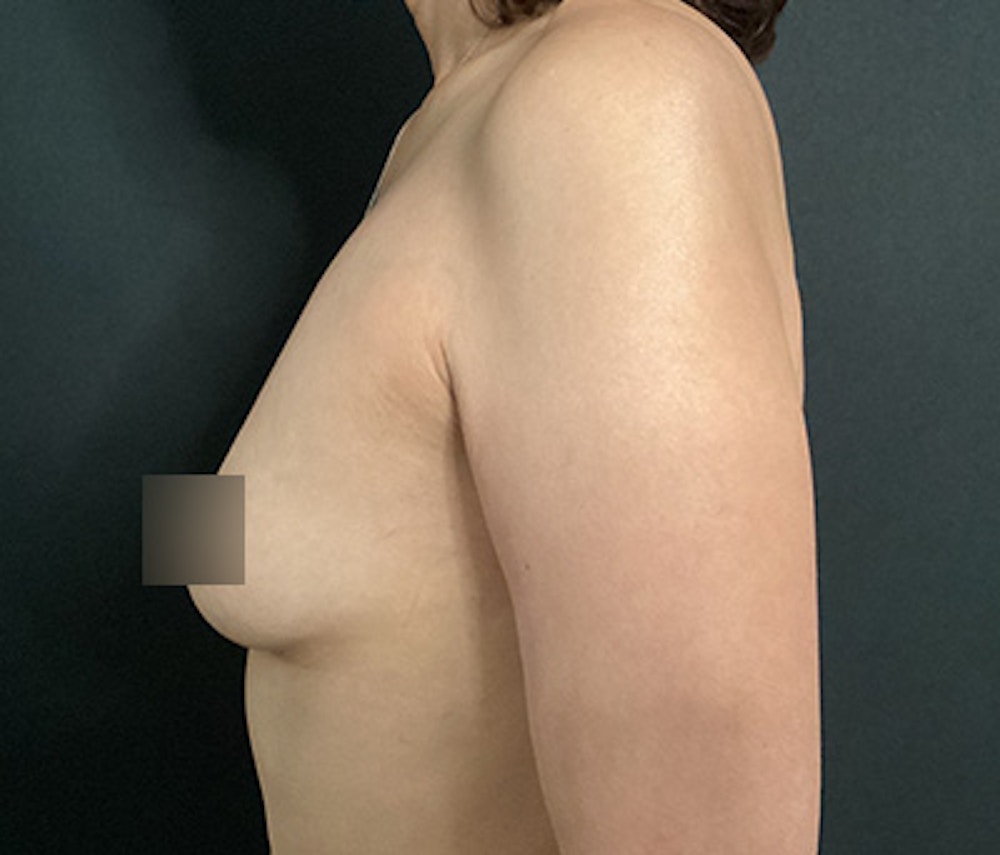 Breast Augmentation Before & After Gallery - Patient 242670 - Image 7