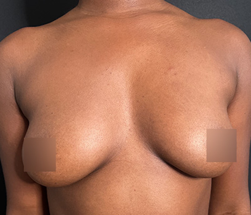 Breast Augmentation Before & After Gallery - Patient 283842 - Image 1