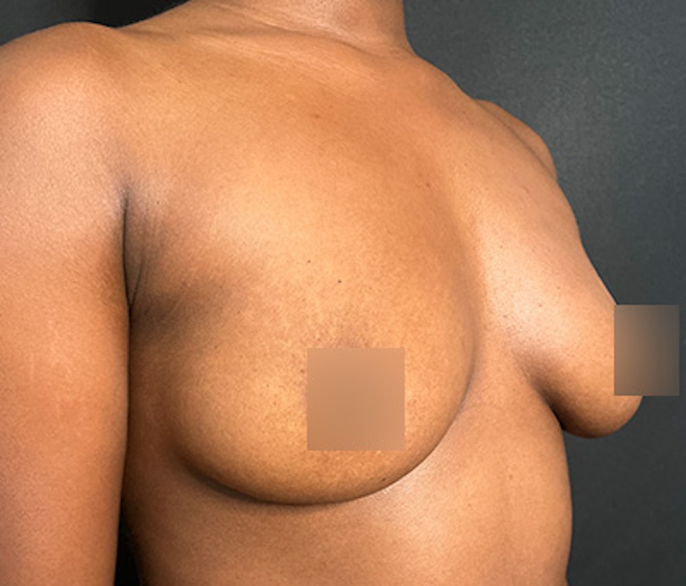 Breast Augmentation Before & After Gallery - Patient 283842 - Image 3