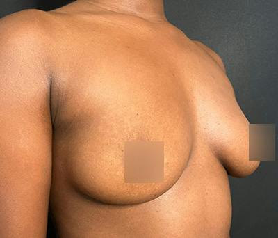 Breast Augmentation Before & After Gallery - Patient 283842 - Image 3