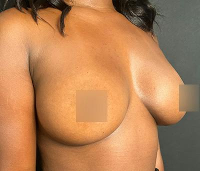 Breast Augmentation Before & After Gallery - Patient 283842 - Image 4