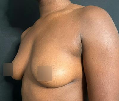 Breast Augmentation Before & After Gallery - Patient 283842 - Image 5