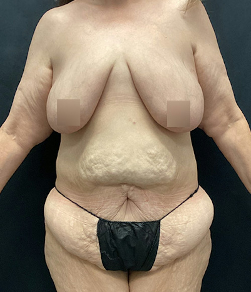 Breast Augmentation Before & After Gallery - Patient 162725 - Image 1