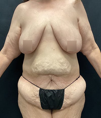 Tummy Tuck Before & After Gallery - Patient 208035 - Image 1