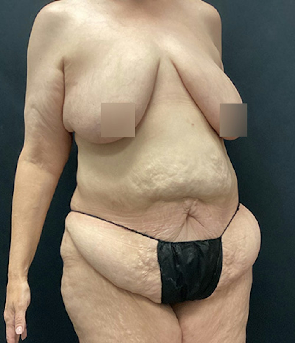 Breast Augmentation Before & After Gallery - Patient 162725 - Image 3