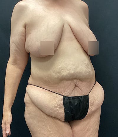 Tummy Tuck Before & After Gallery - Patient 208035 - Image 3
