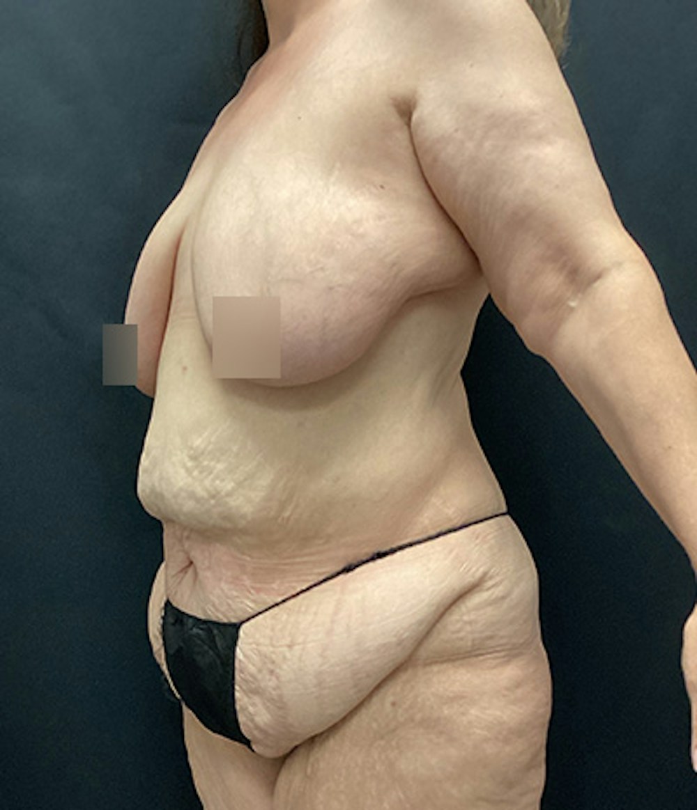 Breast Augmentation Before & After Gallery - Patient 162725 - Image 5