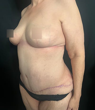 Tummy Tuck Before & After Gallery - Patient 208035 - Image 6
