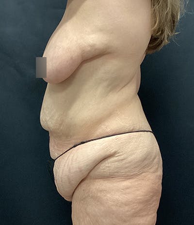 Tummy Tuck Before & After Gallery - Patient 208035 - Image 7