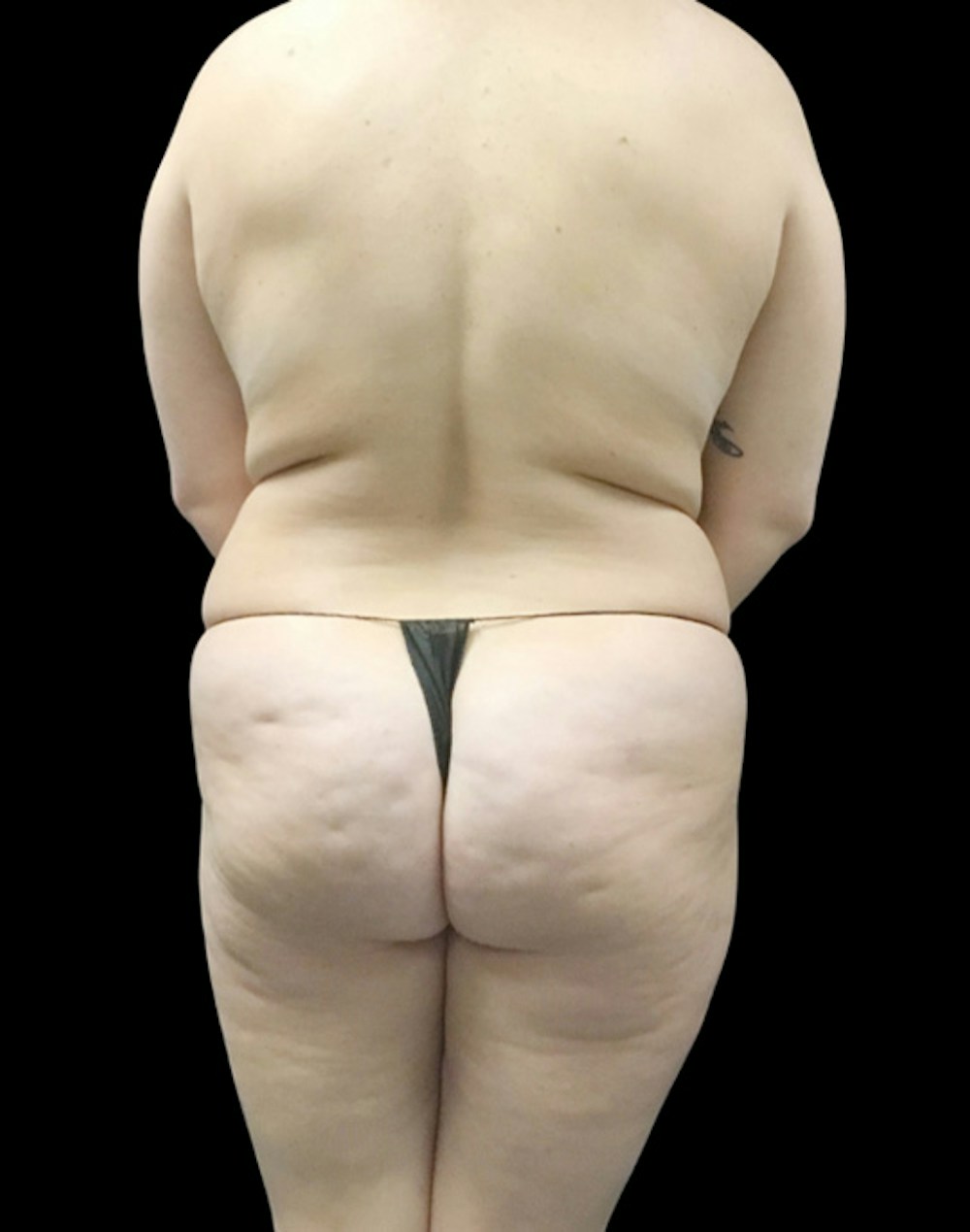 Tight Sculpt with Liposuction Before & After Gallery - Patient 380924 - Image 5