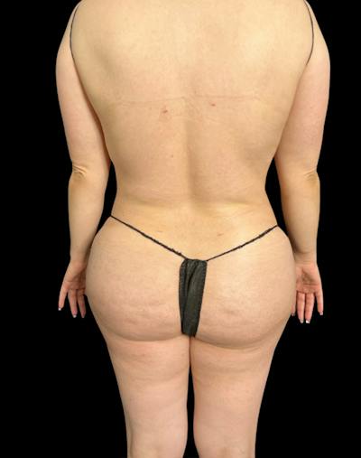 Tight Sculpt with Liposuction Before & After Gallery - Patient 222364 - Image 6