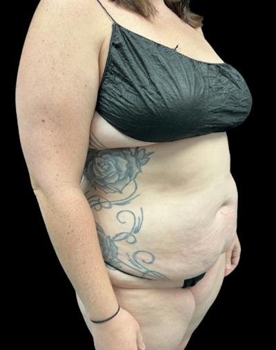 Tight Sculpt with Liposuction Before & After Gallery - Patient 818974 - Image 3