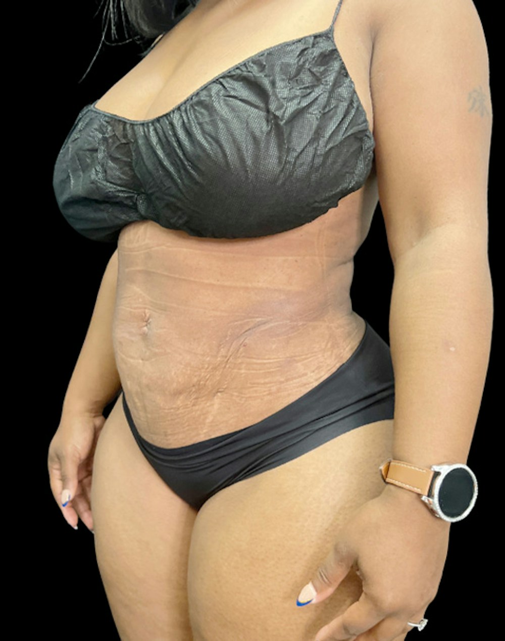 Tight Sculpt with Liposuction Before & After Gallery - Patient 105337 - Image 4