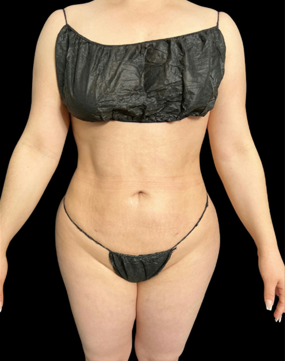 Tight Sculpt with Liposuction Before & After Gallery - Patient 222364 - Image 2