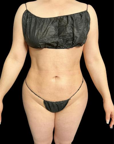 Tight Sculpt with Liposuction Before & After Gallery - Patient 222364 - Image 2