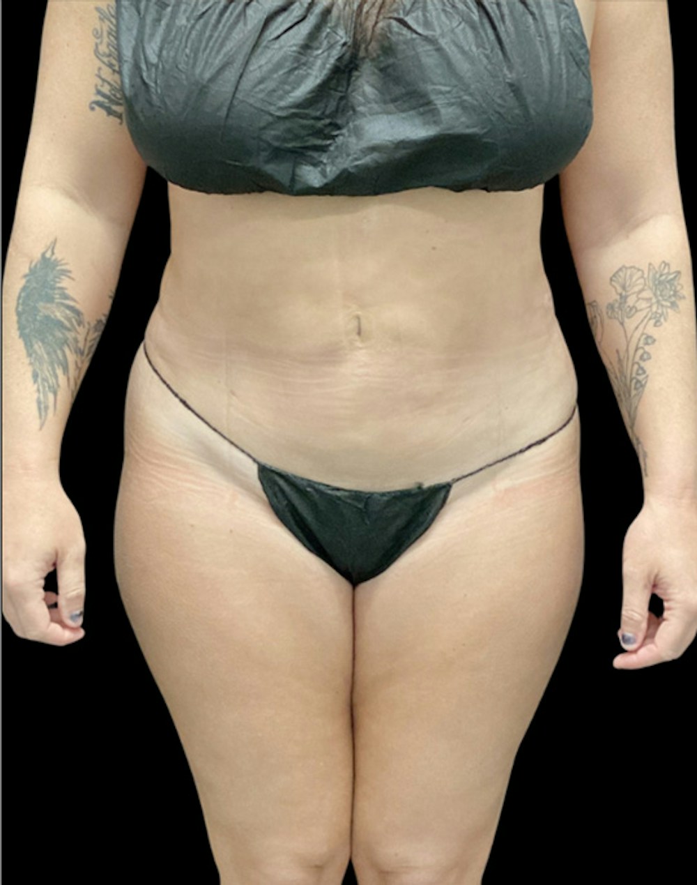 Tight Sculpt with Liposuction Before & After Gallery - Patient 380924 - Image 2