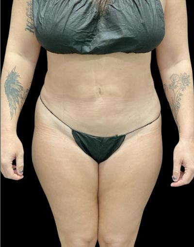 Tight Sculpt with Liposuction Before & After Gallery - Patient 380924 - Image 2
