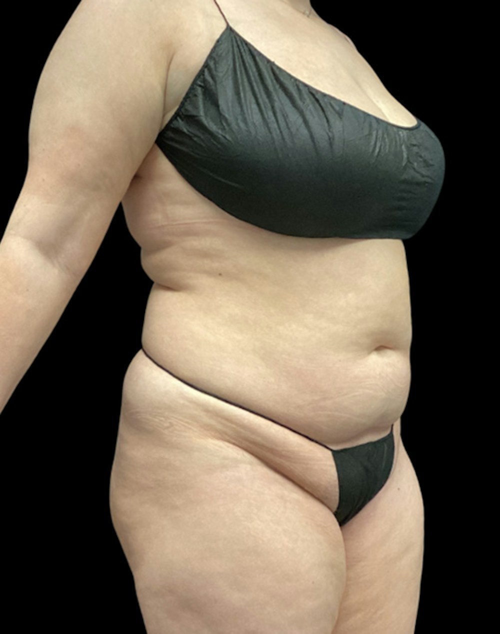 Tight Sculpt with Liposuction Before & After Gallery - Patient 152658 - Image 3