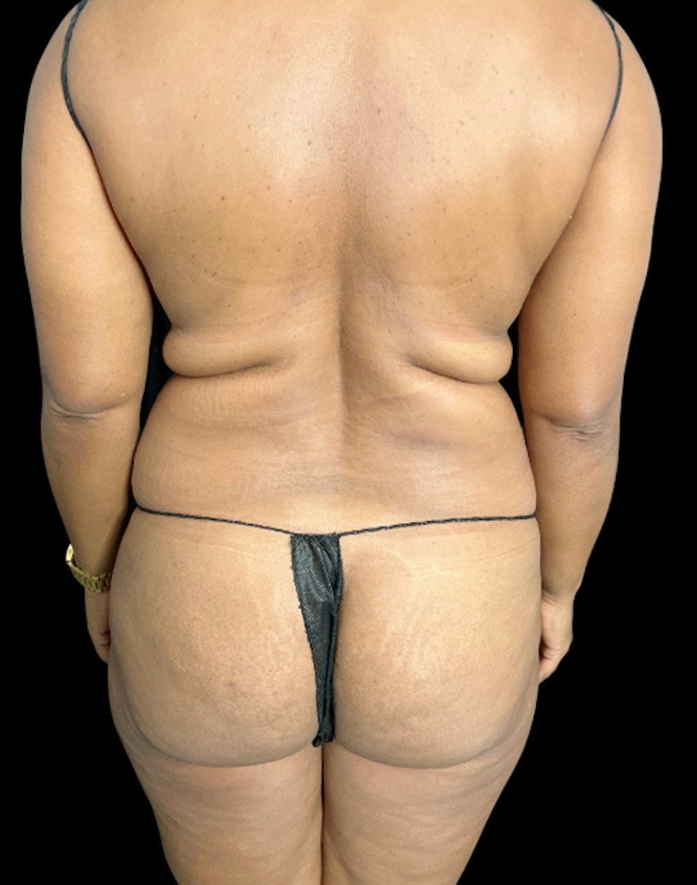 Tight Sculpt with Liposuction Before & After Gallery - Patient 105337 - Image 5