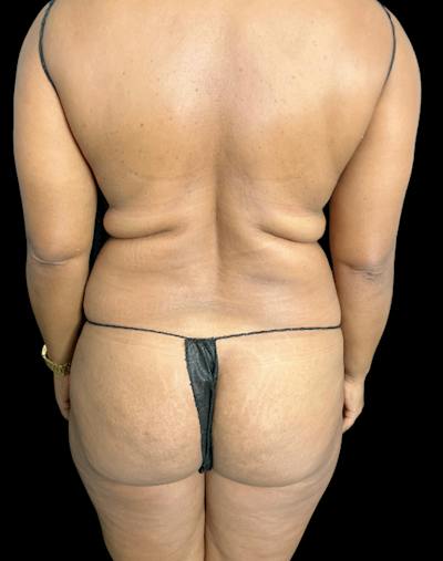 Tight Sculpt with Liposuction Before & After Gallery - Patient 105337 - Image 5
