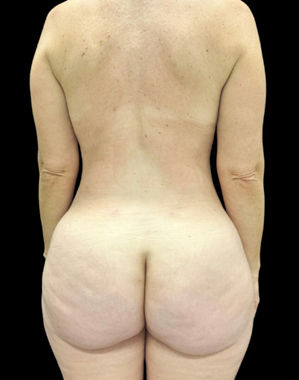 Tight Sculpt with Liposuction Before & After Gallery - Patient 154263 - Image 4