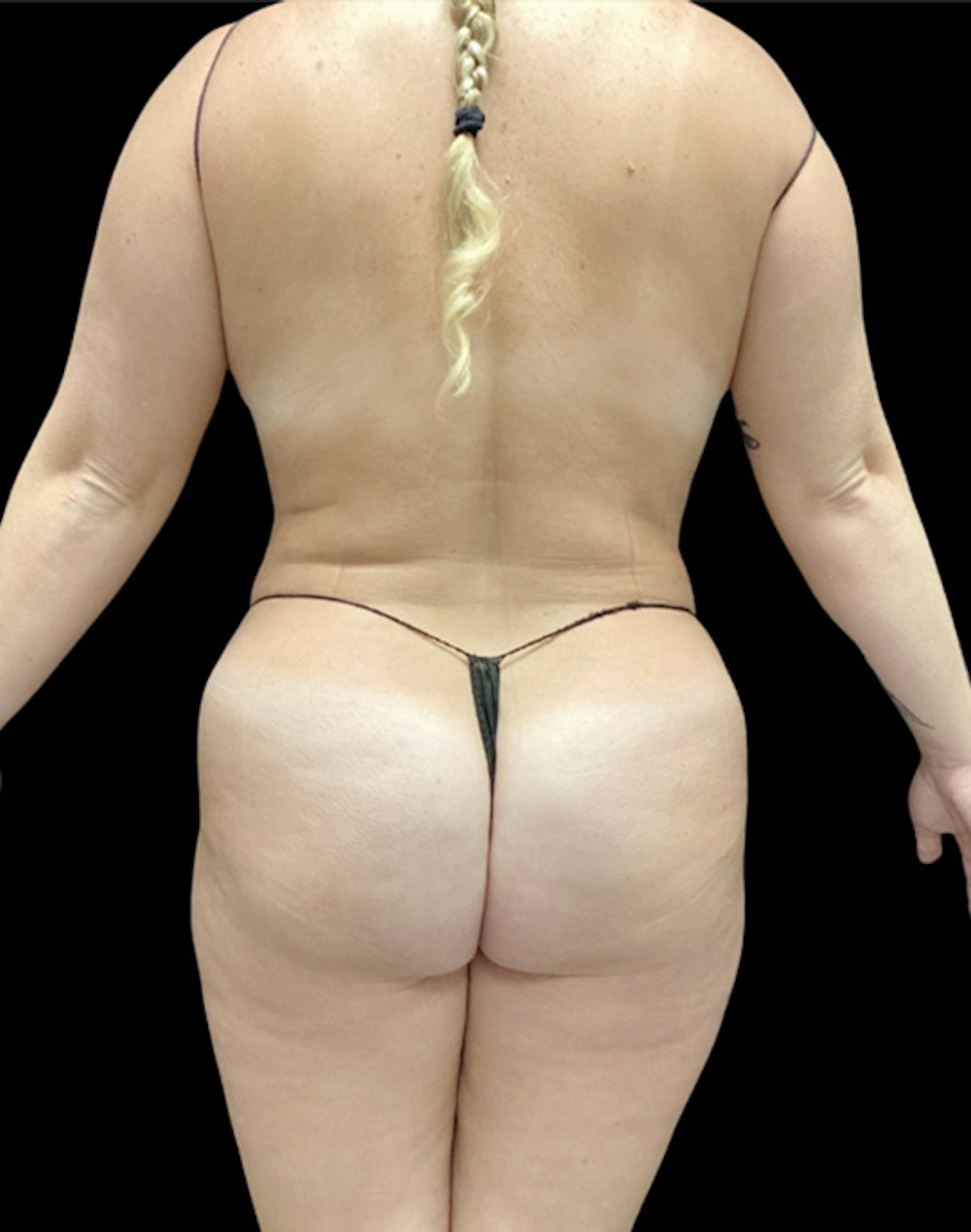 Tight Sculpt with Liposuction Before & After Gallery - Patient 380924 - Image 6