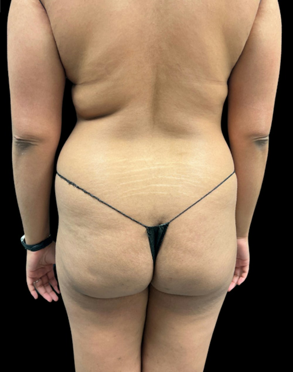 Tight Sculpt with Liposuction Before & After Gallery - Patient 246119 - Image 5