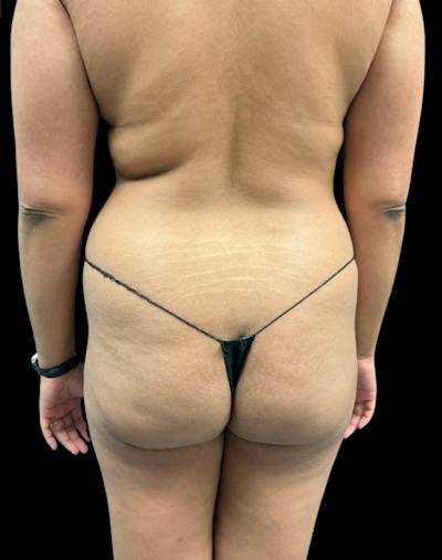 Tight Sculpt with Liposuction Before & After Gallery - Patient 246119 - Image 5