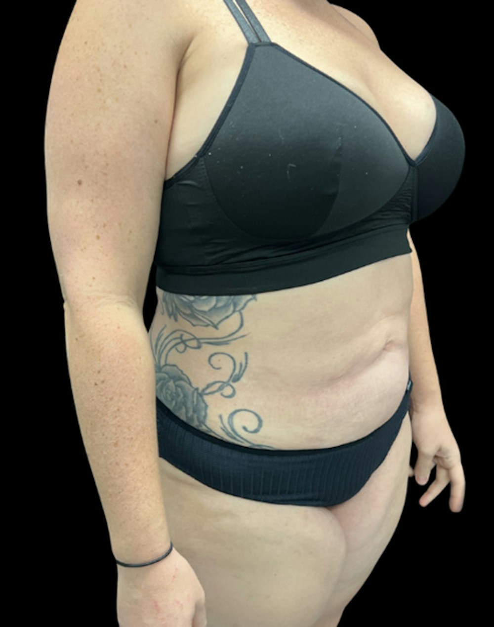 Tight Sculpt with Liposuction Before & After Gallery - Patient 818974 - Image 4